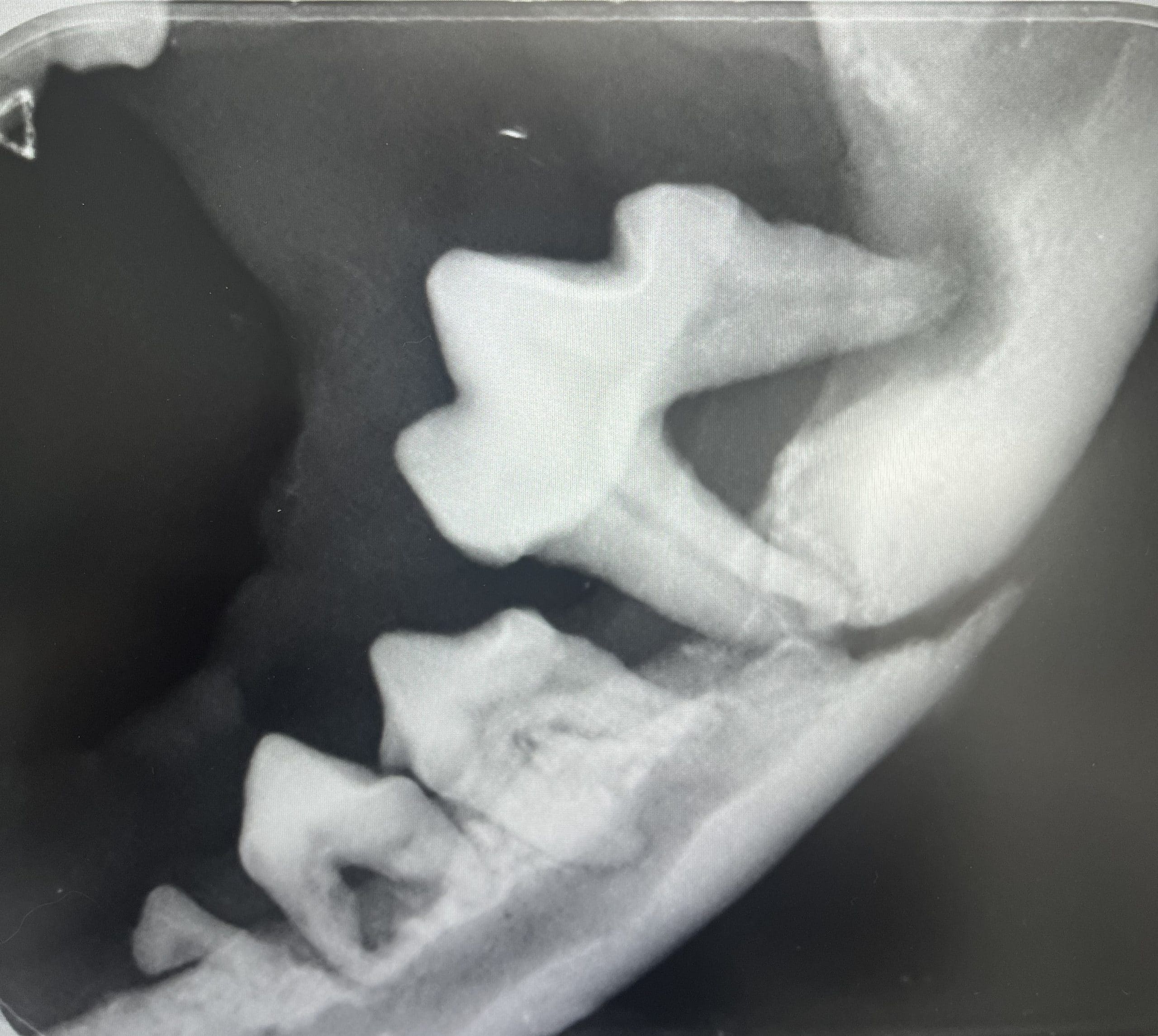 Jaw Fractures - Image 2