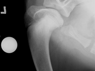 Joint Surgery
