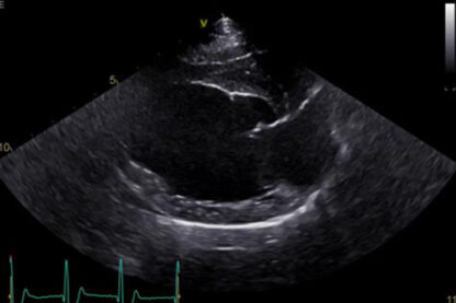 AD150 - Advance25 - Cardiac Ultrasound - Image 3