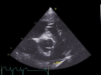 Advanced Echocardiography