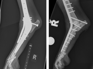 Arthrodesis