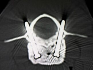 Advanced Spinal Surgery